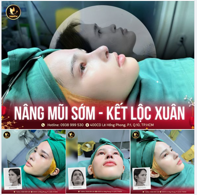 NÂNG MŨI SỚM – KẾT LỘC XUÂN