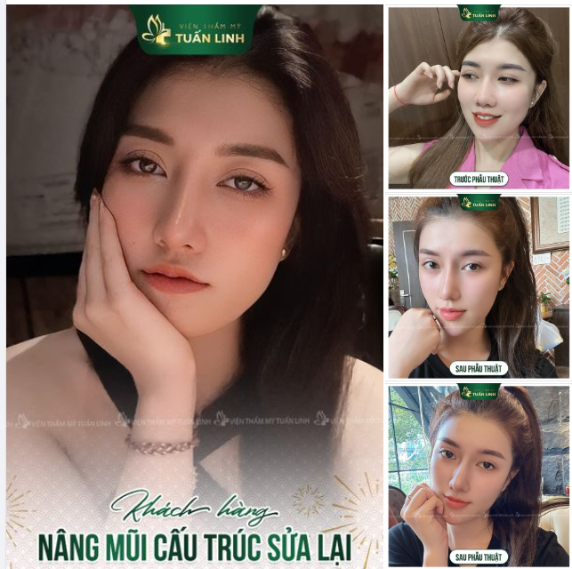 MŨI ĐẸP NGAY - CHI PHÍ TRONG TẦM TAY!!