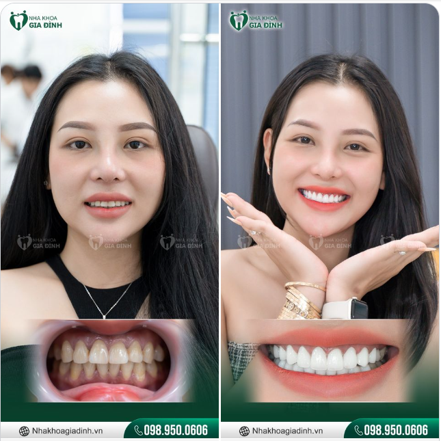 THĂNG HẠNG NHAN SẮC NHỜ NỤ CƯỜI CUỐN HÚT