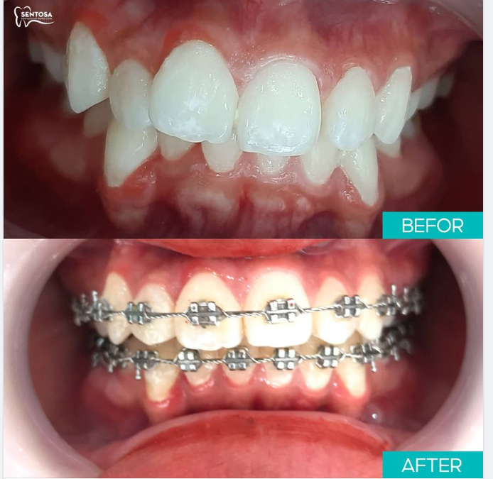 2 NĂM NIỀNG RĂNG BẠN NHẬN LẠI ĐƯỢC GÌ?