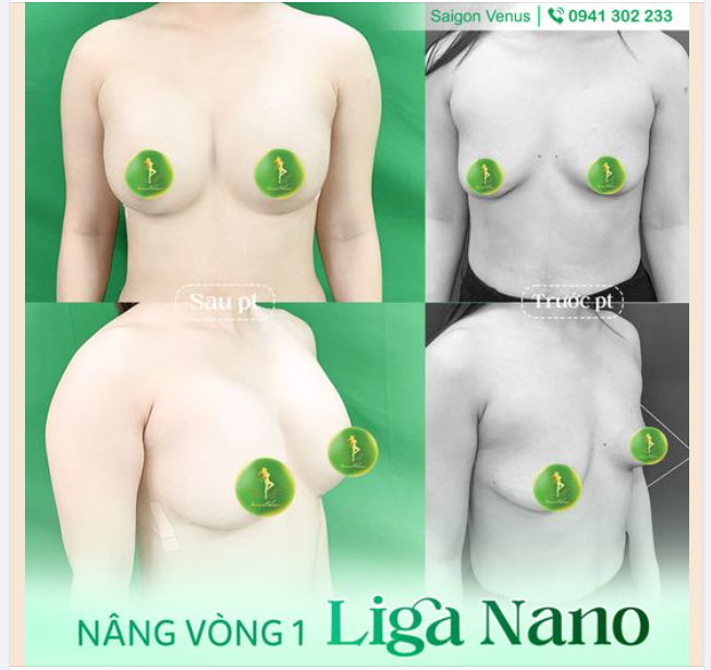 V1 ĐẸP KHÔNG THỂ RỜI MẮT KHI VỚI LIGA NANO