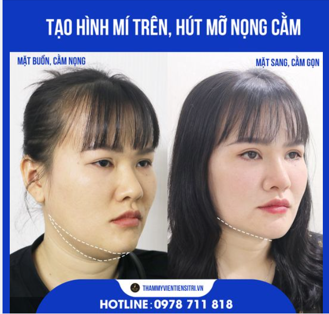Hoàn tất ca: Tạo Hình Mí Trên Hút Mỡ Nọng Cằm