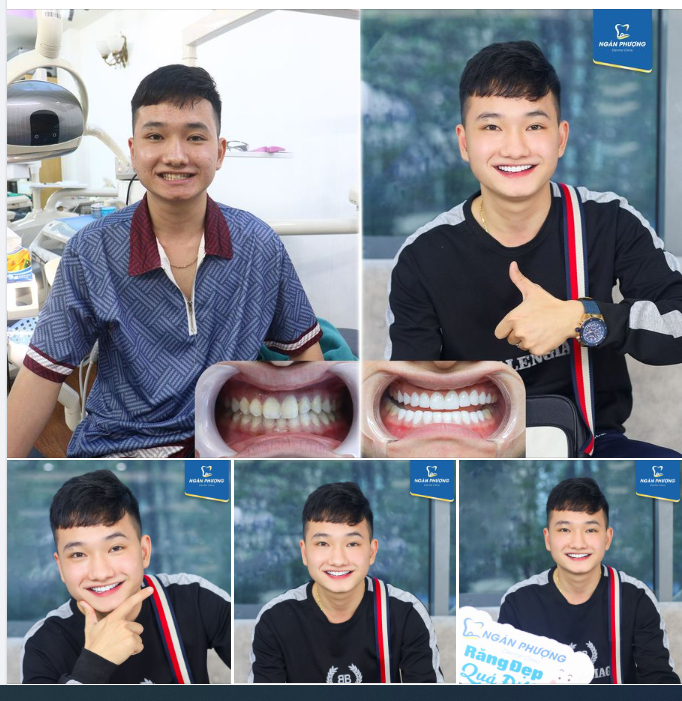 "Em đã tìm hiểu rất kỹ cũng như có tham khảo người quen làm dán sứ 5 - 6 năm rồi vẫn đẹp, không gặp vấn đề gì cả."