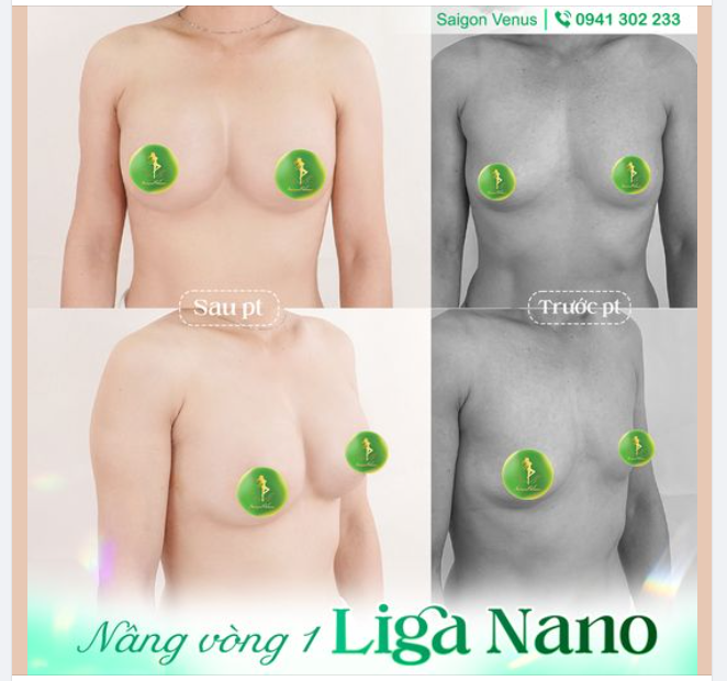 GIẢI PHÁP NÀO ĐỂ SỞ HỮU V1 ĐẸP HOÀN HẢO
