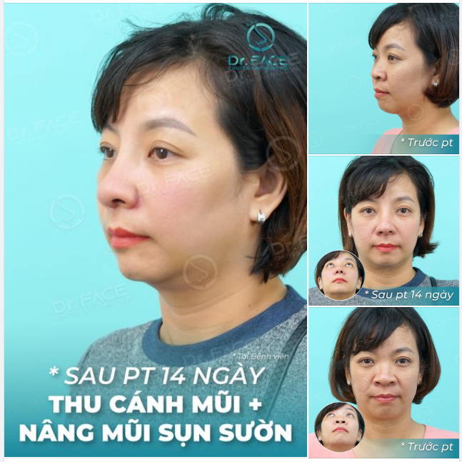 Kìa bạn, nhìn ảnh này bạn còn phủ nhận “giá trị” của phương pháp nâng mũi sụn sườn nữa hay không?