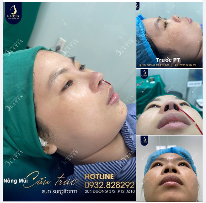 Hành trình sở hữu dáng mũi cao thanh tú mong ước bấy lâu nay