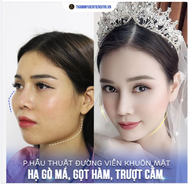 Combo Hạ gò má, Gọt Hàm, Trượt Cằm. Tái Định Hình Đường Viền Khuôn Mặt