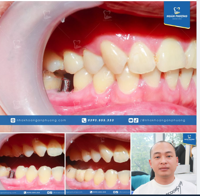 Tại sao khi mất răng hàm 1 bên sẽ dễ hỏng cả răng đối xứng?