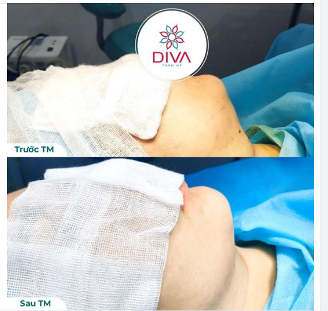 GIẢM MỠ NỌNG CẰM – SỞ HỮU CẰM THON GỌN SAU THẨM MỸ