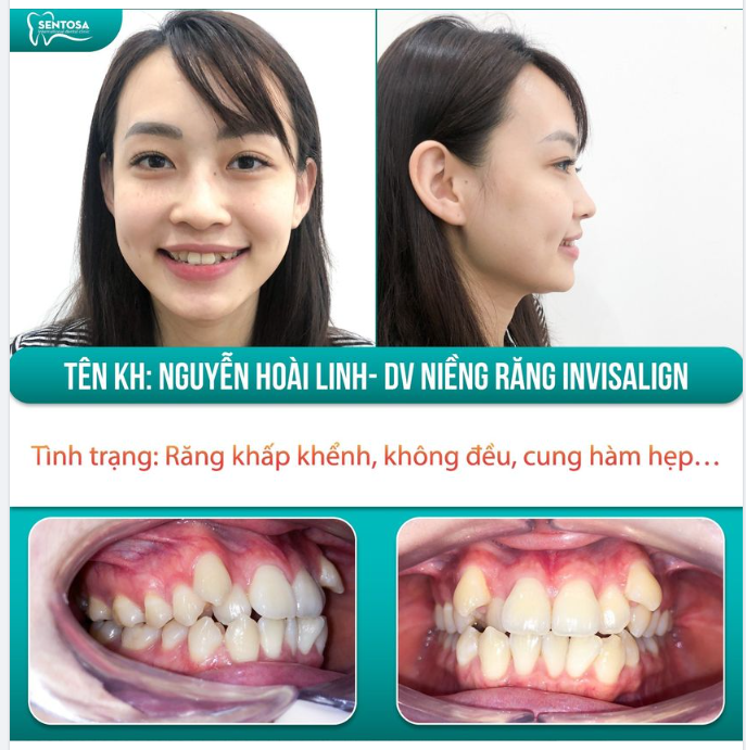 GỌI LÀ RĂNG KHỂNH THÌ KHÔNG NÊN NIỀNG?