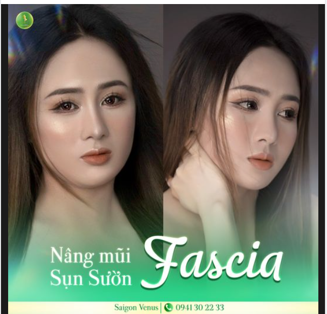 FEEDBACK KHOE DÁNG MŨI CẤU TRÚC SỤN SƯỜN FASCIA SAU 1 THÁNG THỰC HIỆN 