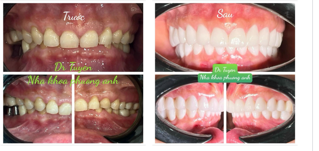 Hình ảnh BN trước và sau Chỉnh nha - cấy ghép Implant và phục hình răng sứ thẩm mỹ toàn hàm