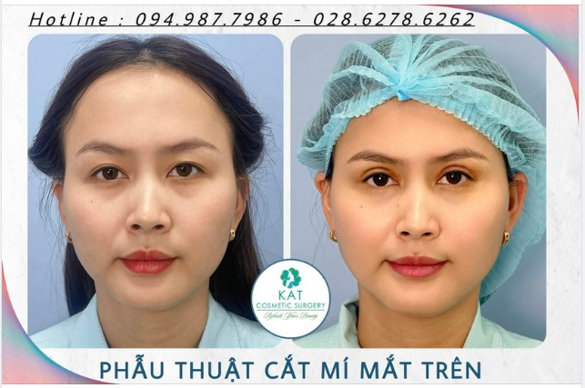 Tại sao nhiều bạn trẻ lại cần cắt mí trên mà không thể bấm mí?