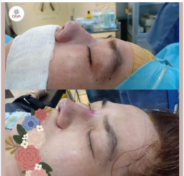 NÂNG MŨI SLINE - MŨI ĐẸP ĐÓN TẾT TÀI LỘC!