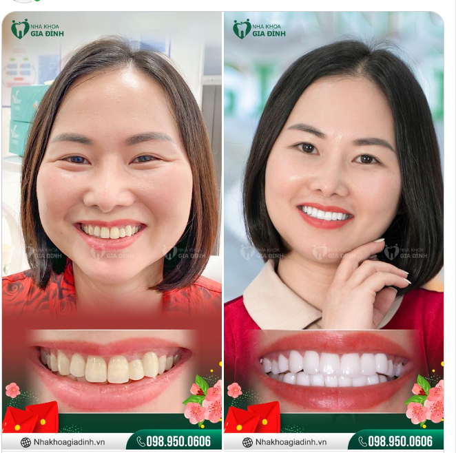 TẾT NÀY ĐỪNG ĐỂ HÀM RĂNG XẤU LÀM MẤT ĐI SỰ TỰ TIN CỦA BẠN