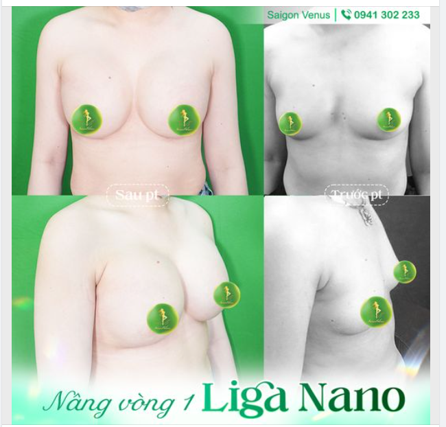 V1 ĐẸP CĂNG TRÀN VỚI NÂNG LIGA NANO TẠI SAIGON VENUS