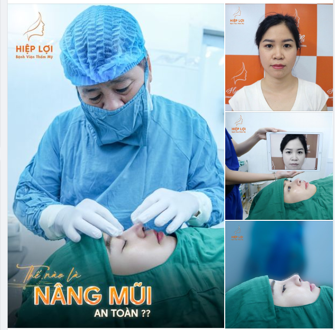 NÂNG MŨI CÓ THẬT SỰ AN TOÀN KHÔNG?