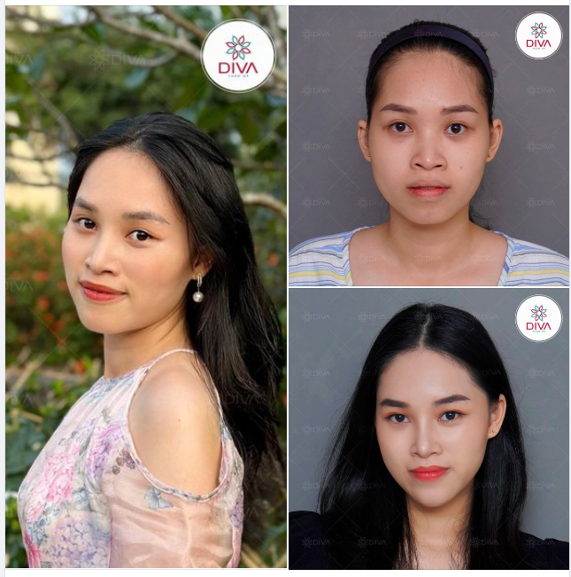 MẶT THON GỌN THU HÚT SAU THỰC HIỆN 4 DỊCH VỤ THẨM MỸ