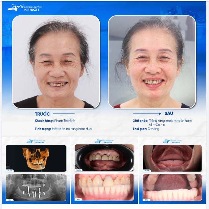 SỤT CÂN VÌ MẤT RĂNG - U80 TÌM LẠI CÂN NẶNG NHỜ PHƯƠNG PHÁP NÀY