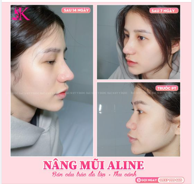 NÂNG MŨI ALINE - CHÍNH TAY BÁC SĨ KỲ Y DƯỢC THỰC HIỆN