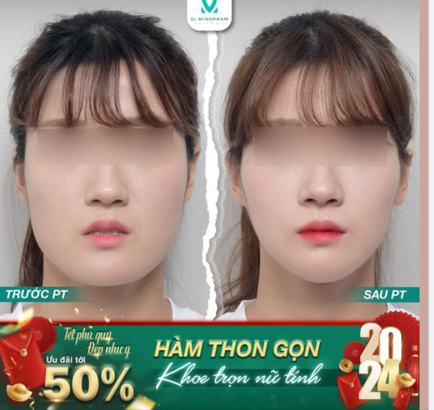 Gọt hàm Dr Minh Phạm giúp chị em sở hữu khuôn mặt V-Line vạn người mê.