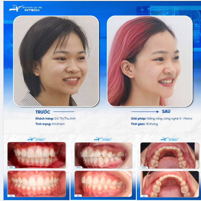 "NIỀNG RĂNG LÀM THAY ĐỔI CẢ KHUÔN MẶT, CẰM V-LINE VÀ MŨI CŨNG CAO LÊN ..."
