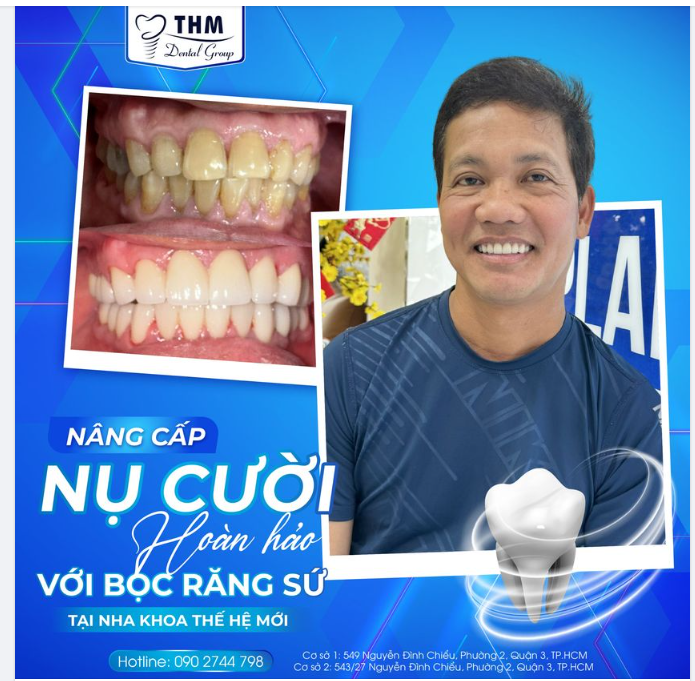 PHỤC HÌNH RĂNG SỨ - NÂNG CẤP NỤ CƯỜI HOÀN HẢO TẠI NHA KHOA THẾ HỆ MỚI