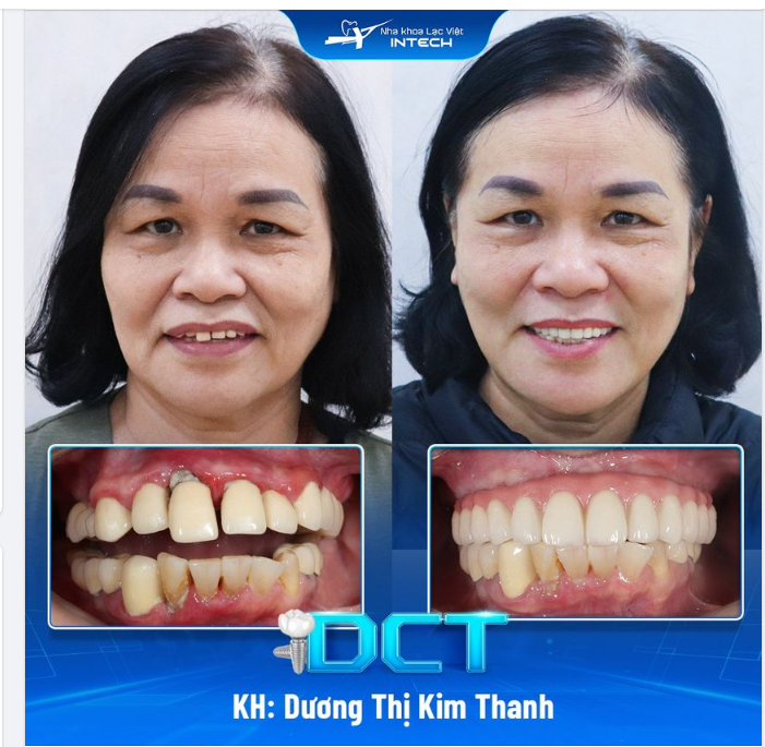 ĐỪNG ĐỂ MẤT RĂNG TRỞ THÀNH GÁNH NẶNG