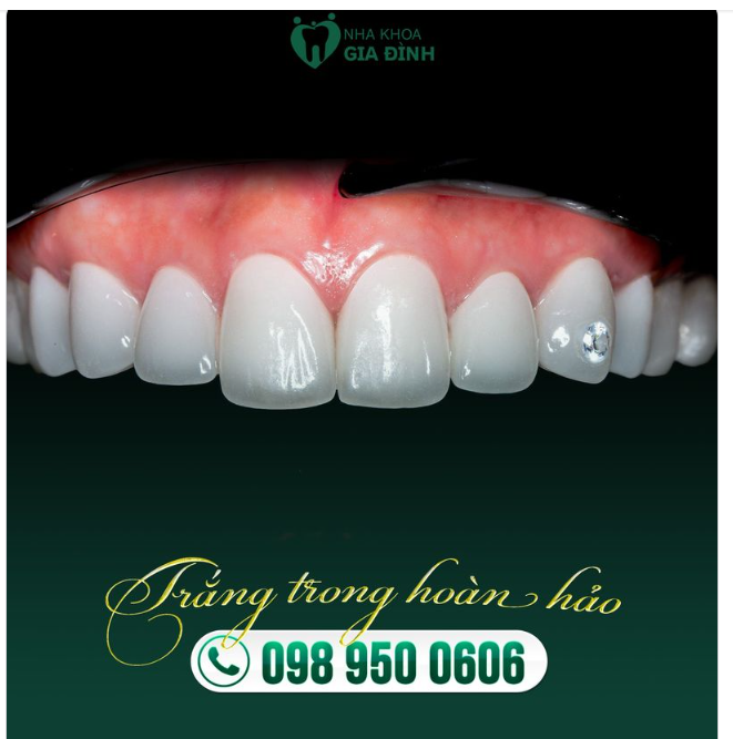LỚP SỨ TRẮNG TRONG - FORM RĂNG THỜI THƯỢNG