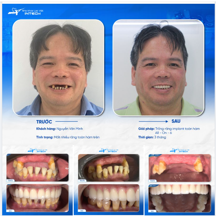 VỀ VIỆT NAM TRỒNG RĂNG IMPLANT, VIỆT KIỀU ĐỨC NHẬN ĐƯỢC KẾT QUẢ NHƯ THẾ NÀO TẠI LẠC VIỆT INTECH?