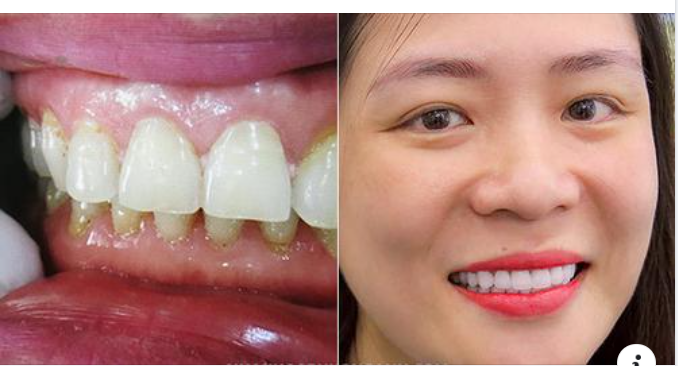 Vì Sao Viền Nướu Bị Đen Sau Khi Bọc Răng Sứ?