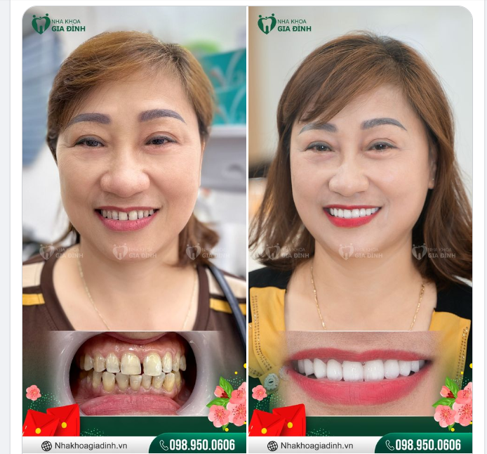 RĂNG TRẮNG CƯỜI XINH - TỰ TIN ĐÓN TẾT
