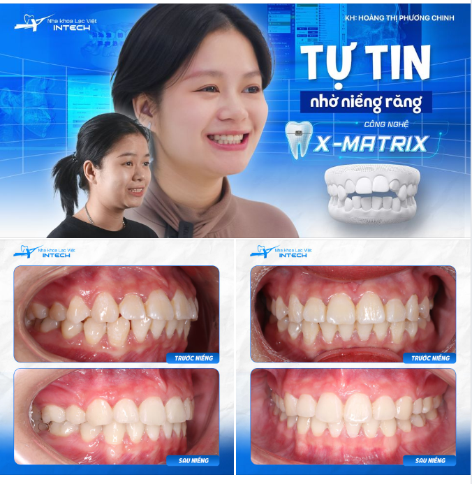 RĂNG XẤU ẢNH HƯỞNG ĐẾN CÔNG VIỆC - CÔ NÀNG 9X VỘI VÀNG TÌM GIẢI PHÁP