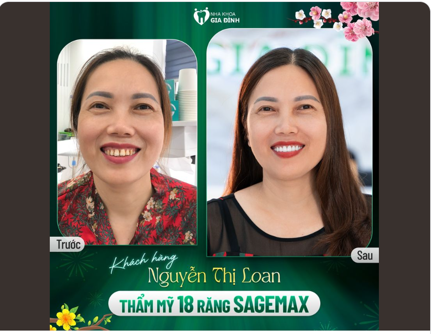 CHỈ 2 LẦN HẸN SỞ HỮU NGAY NỤ CƯỜI ĐẸP NHƯ CHỊ ẤY
