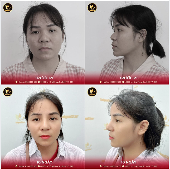 Dáng mũi  “gây thương nhớ ” cho biết bao chị em