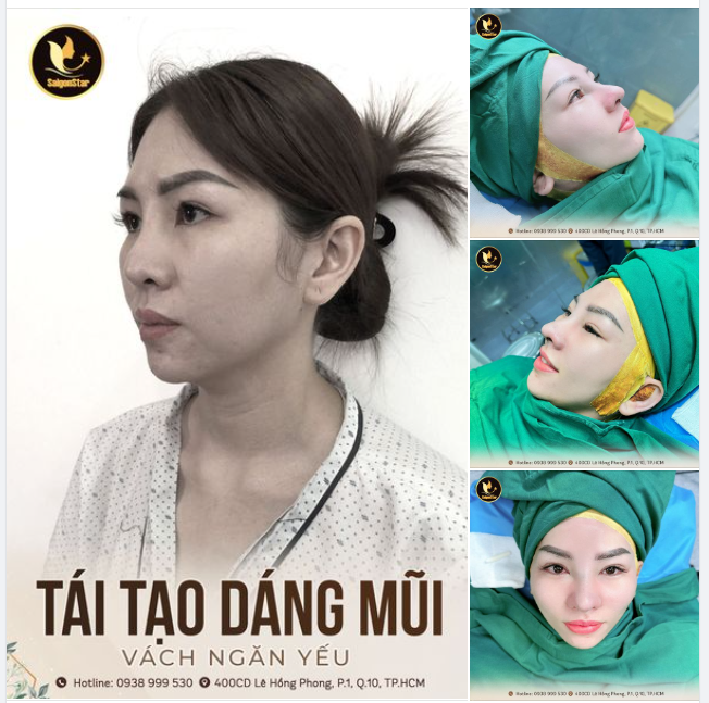 TÁI TẠO DÁNG MŨI SAU 13 NĂM