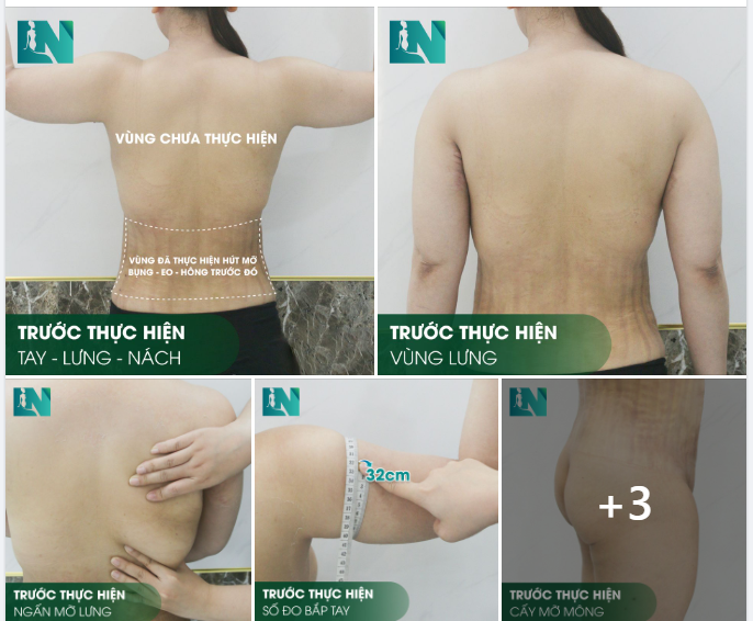 HÚT MỠ TAY - LƯNG - NÁCH KẾT HỢP CẤY MỠ MÔNG - BÍ QUYẾT TẠO NÊN SẮC VÓC HOÀN MỸ