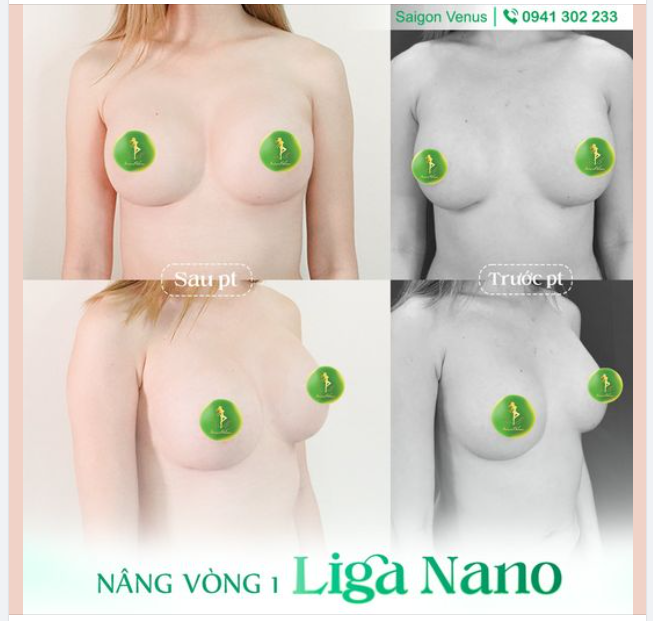 THAY ĐỔI V1 VỚI GIẢI PHÁP LIGA NANO
