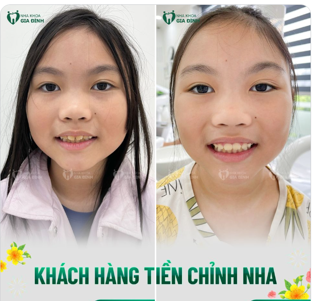 Niềng răng sớm cho trẻ luôn được các chuyên gia nha khoa khuyến khích bởi trẻ sẽ nhận được nhiều lợi ích sau đó: