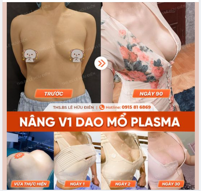 NÂNG NGỰC BAO LÂU HỒI PHỤC?