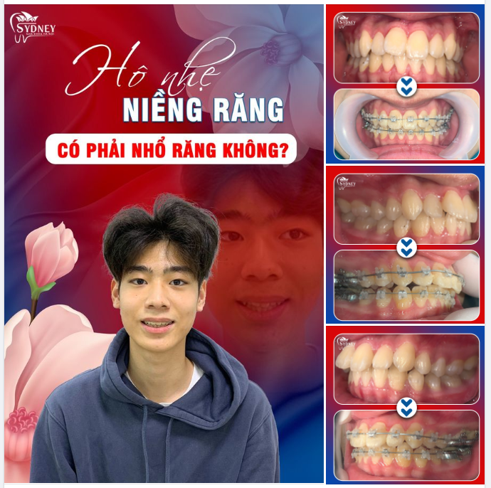 HÔ NHẸ KHI NIỀNG RĂNG CÓ PHẢI NHỔ RĂNG KHÔNG?