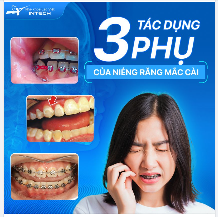 “TÁC DỤNG PHỤ” KHI NIỀNG RĂNG MẮC CÀI