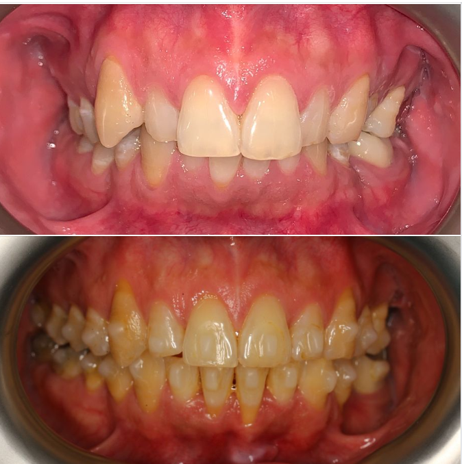 Niềng răng Invisalign tại nha khoa Lan Anh, kết quả đạt được rất tốt, mà lại không phải nhổ răng!