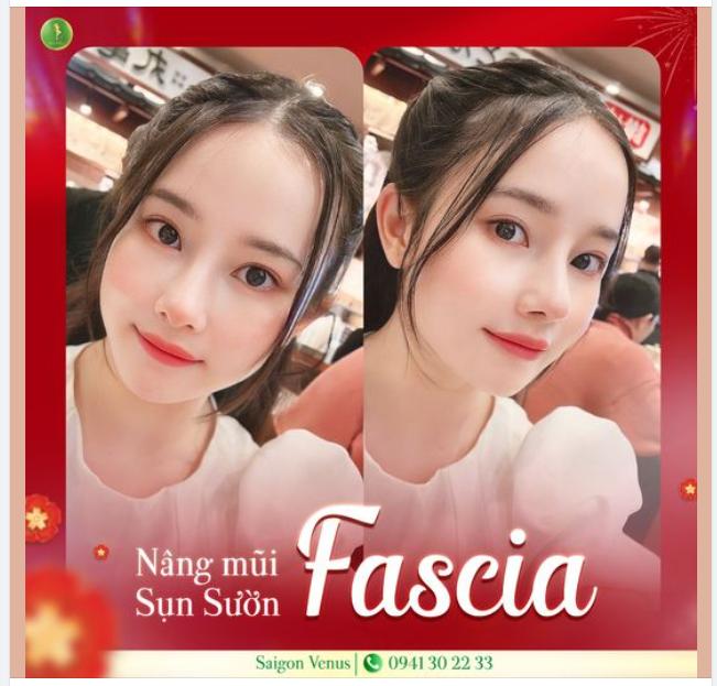 MŨI ĐẸP KỊP TẾT - THỜI ĐIỂM VÀNG NÂNG MŨI