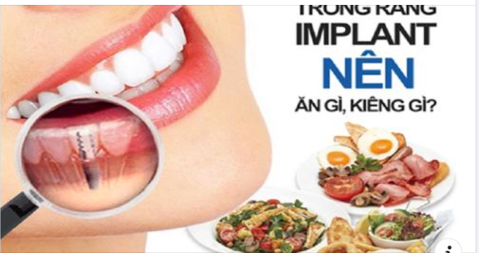 Trồng răng implant bao lâu thì ăn được?