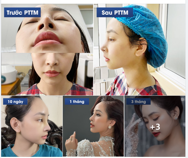 Vốn có khuôn mặt ưa nhìn nhưng chiếc mũi lại là khuyết điểm duy nhất của bạn khách Hoàng Phúc. Tình trạng mũi của bạn khách trước khi đến Thẩm mỹ Như Hoa: