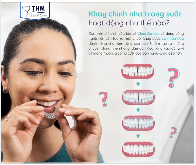 NIỀNG RĂNG TRONG SUỐT CLEARCORRECT - GIẢI PHÁP TOÀN DIỆN CHO NỤ CƯỜI MỚI