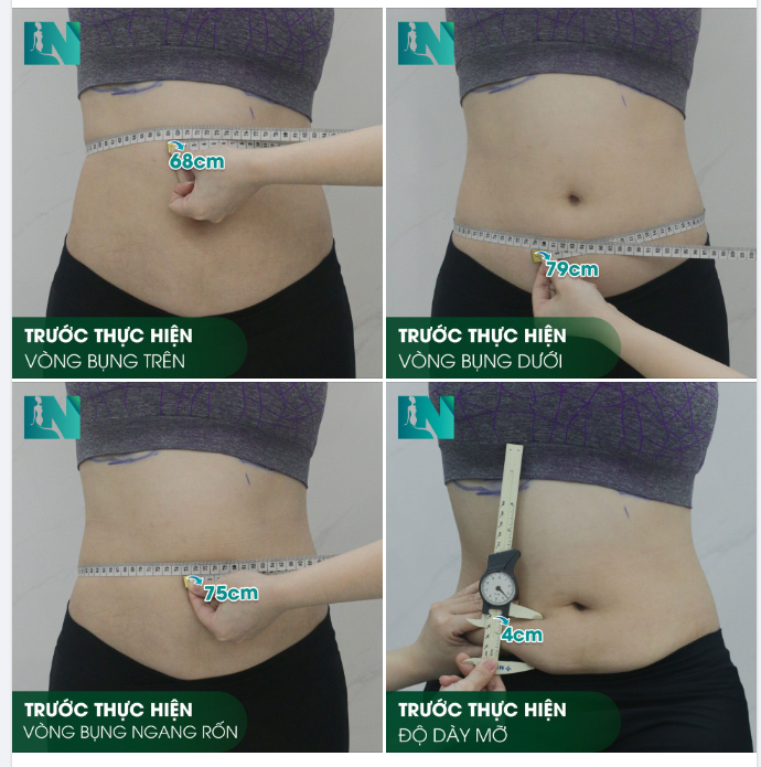 HÌNH ẢNH TRƯỚC KHI THỰC HIỆN HÚT MỠ TẠO DÁNG BỤNG - EO - HÔNG CỦA CHỊ KHÁCH HÀNG SINH NĂM 1988