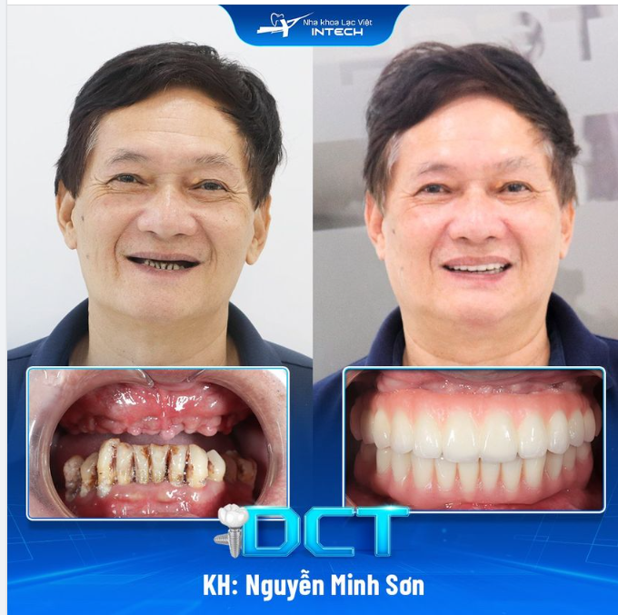 ỨNG DỤNG CÔNG NGHỆ TRỒNG RĂNG IMPLANT DCT CHO BỆNH NHÂN MẤT RĂNG, HIỆU QUẢ BAO NHIÊU %?