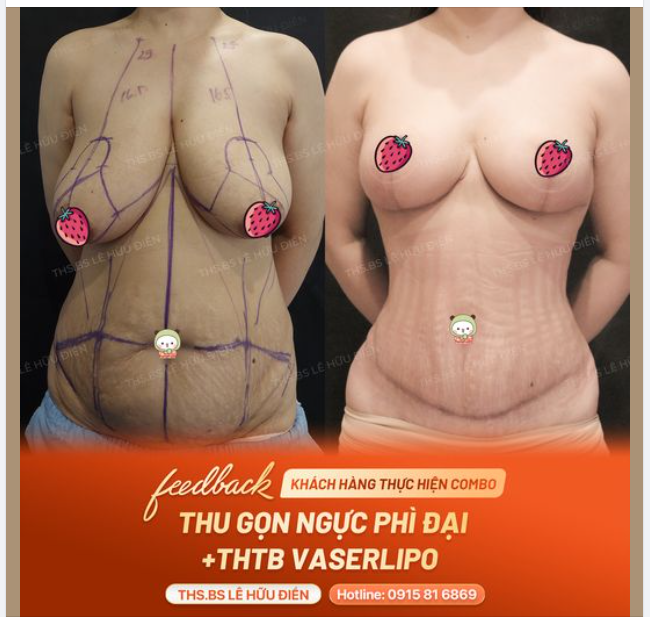 Bạn đã bao giờ cảm thấy bất lực vì bụng to, ngực chảy xệ thân hình không như ý chưa?